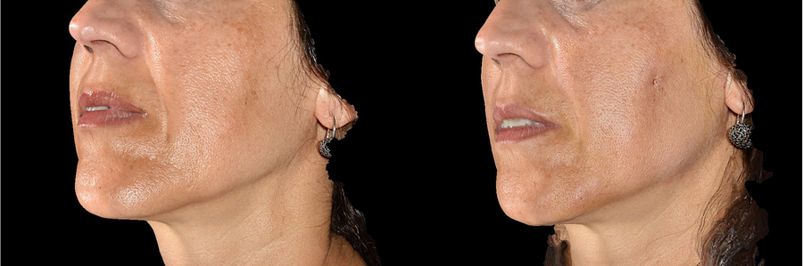 Solchi naso-genieni subito dopo fili riassorbibili (immagine 3D)