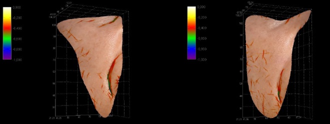 Stessa paziente. Misurazione computerizzata 3D profondità solco naso-genieno dx