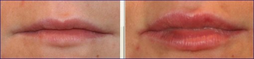 Figura 4. Labbra prima e subito dopo trattamento con filler a base di acido ialuronico