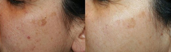 Lentigo senili - Skin Center Centro Laser Dermoestetico Pescara