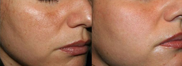 Melasma - Skin Center Centro Laser Dermoestetico Pescara