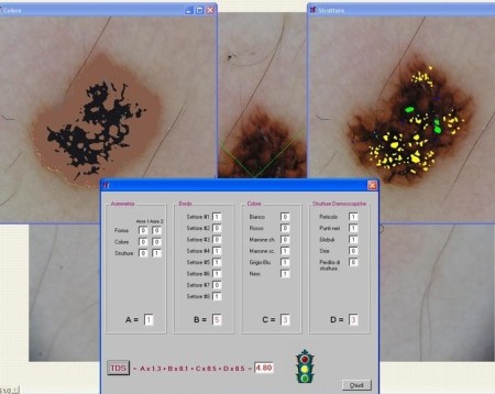 PREVENIRE IL MELANOMA CON LA VIDEODERMATOSCOPIA DIGITALE COMPUTERIZZATA domenico piccolo skin center