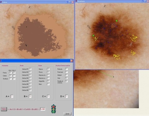 PREVENIRE IL MELANOMA CON LA VIDEODERMATOSCOPIA DIGITALE COMPUTERIZZATA domenico piccolo skin center